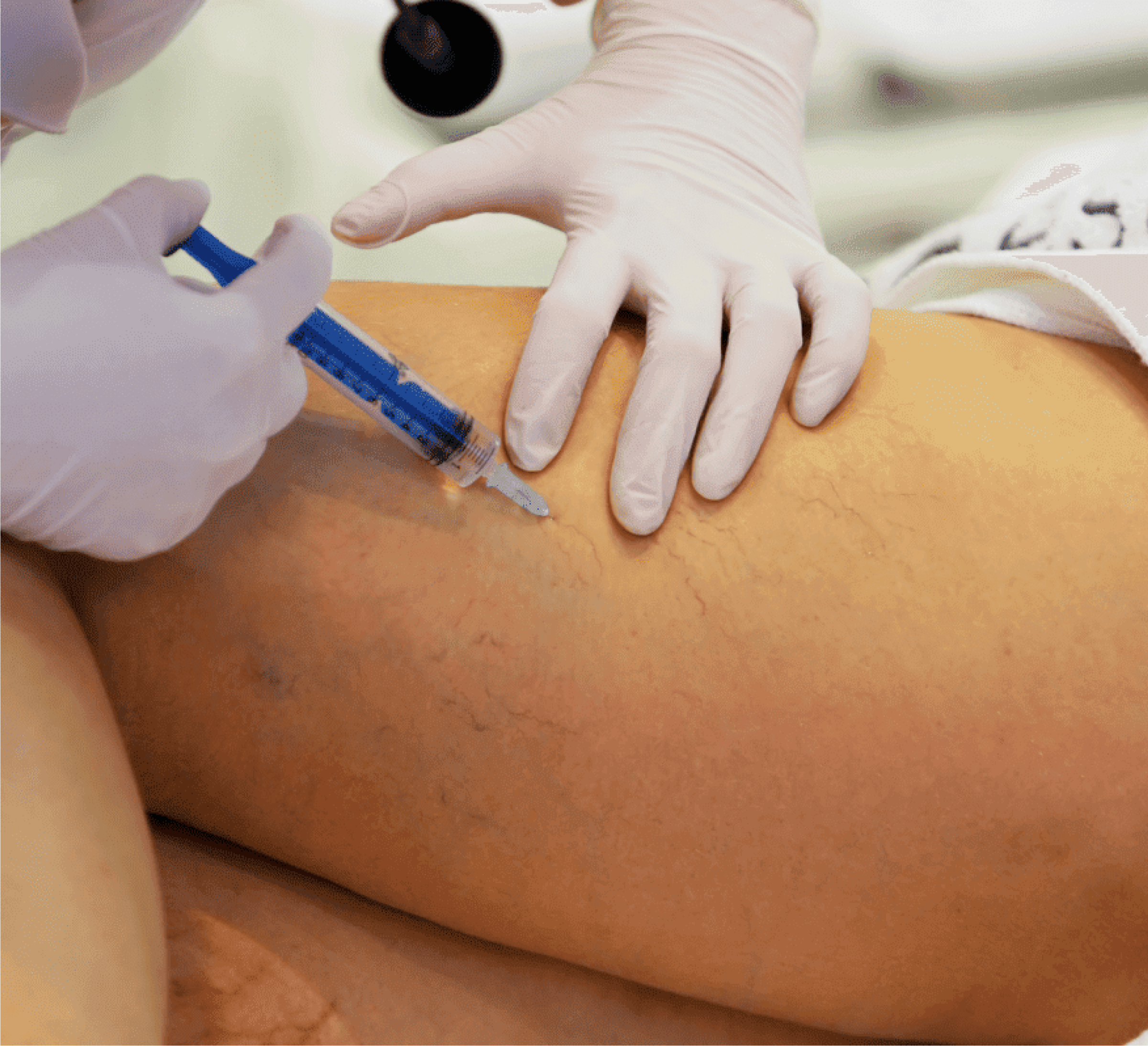 Curso de Capacitação - Escleroterapia